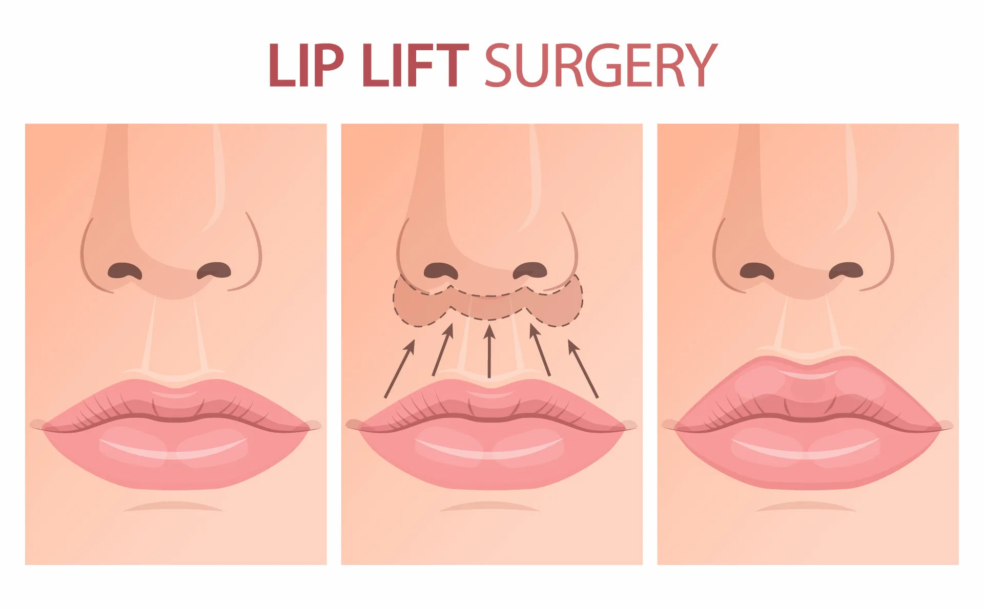 lip lift