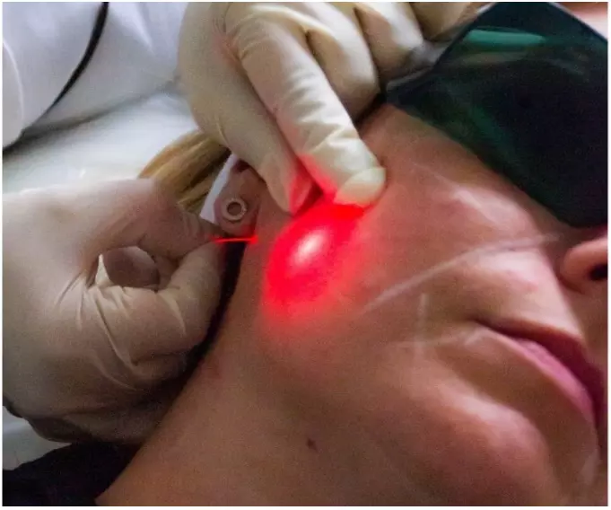 endolift yüz germe