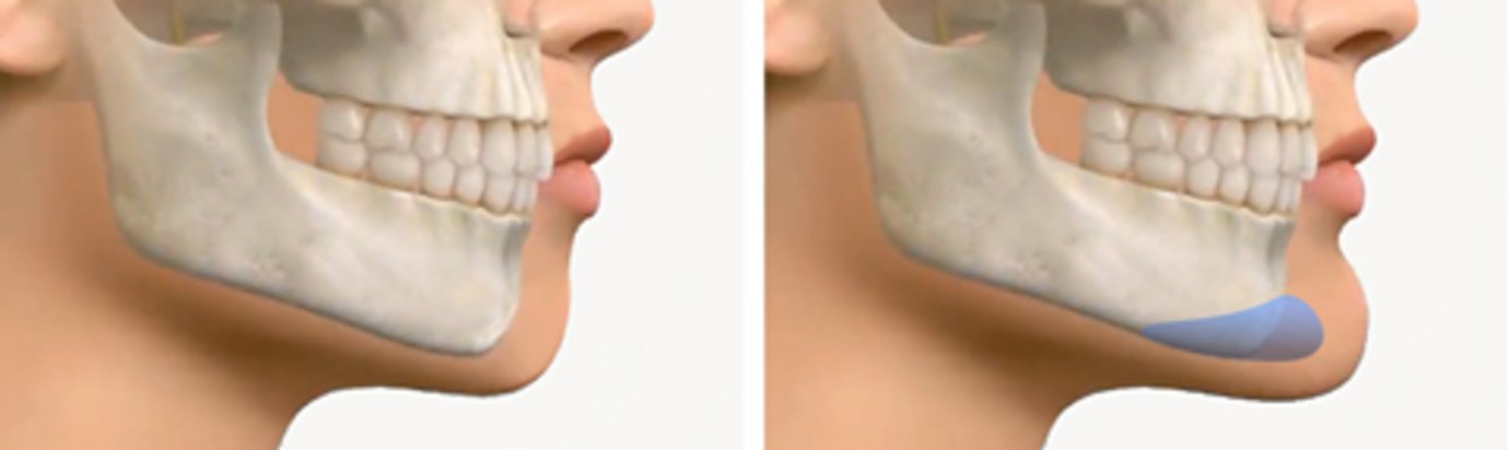 chin aesthetics