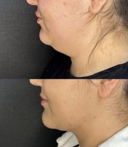 double chin liposuction cost in turkey