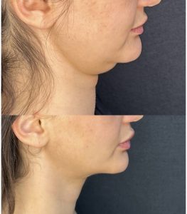 double chin liposuction cost turkey