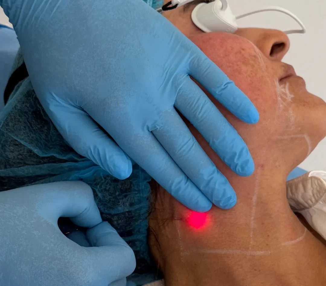 endolift double chin