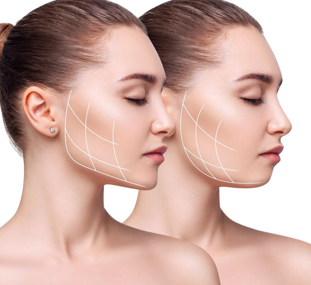 jawline filler istanbul