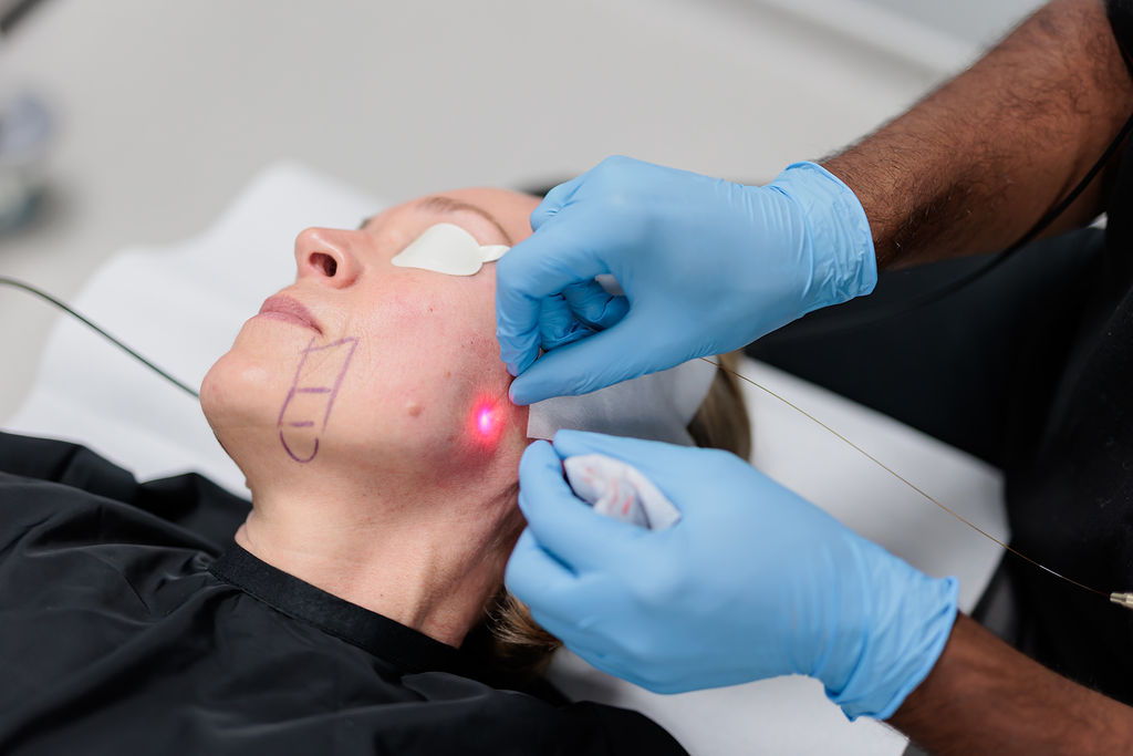 non-surgical endolift laser facelift