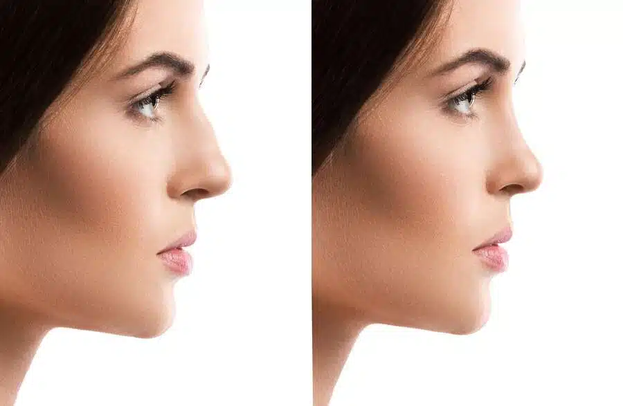 non-surgical rhinoplasty istanbul